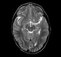 Callosal dysgenesis and ectopic posterior pituitary (Radiopaedia 8382-9213 Axial T2 9).jpg