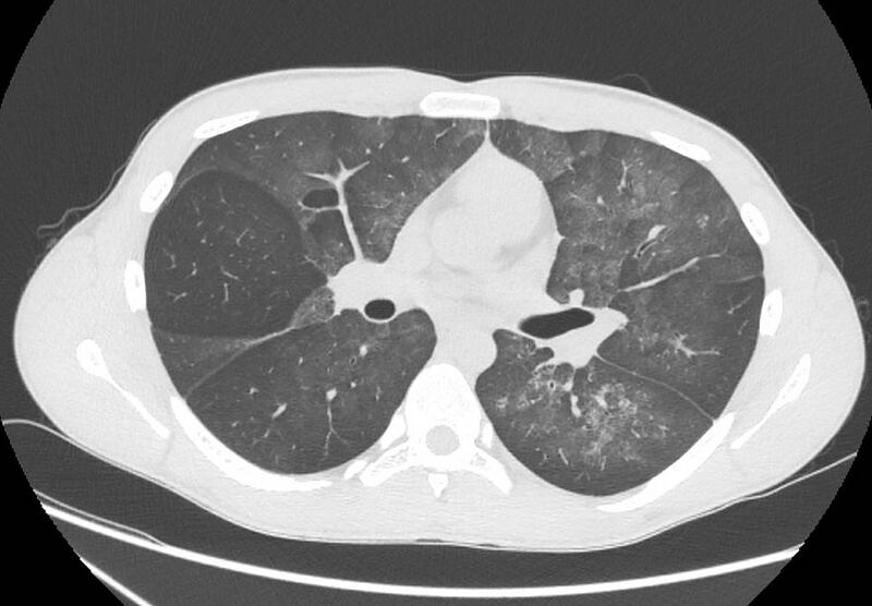 File:Cannabis-induced diffuse alveolar hemorrhage (Radiopaedia 89834-106946 Axial lung window 53).jpg