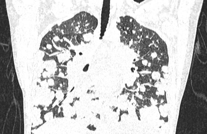 File:Cannonball metastases from breast cancer (Radiopaedia 91024-108569 Coronal lung window 77).jpg