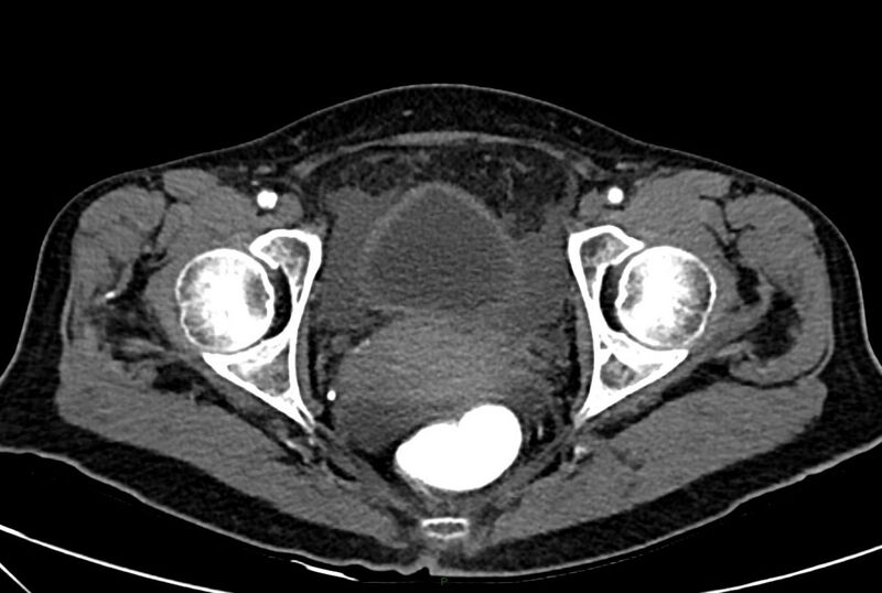 File:Carcinoid mesenteric tumor complicated by chylous ascites (Radiopaedia 76312-88926 A 72).jpg