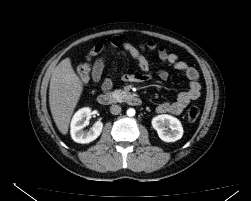 Carcinoid tumor with hepatic metastases (Radiopaedia 22651-22670 B 39).jpg