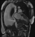 Cardiac amyloidosis (Radiopaedia 51404-57150 B 6).jpg
