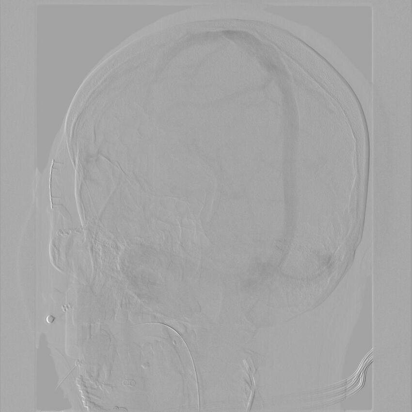 Caroticocavernous fistula - direct (Radiopaedia 61660-69666 Oblique Left ICA 64).jpg