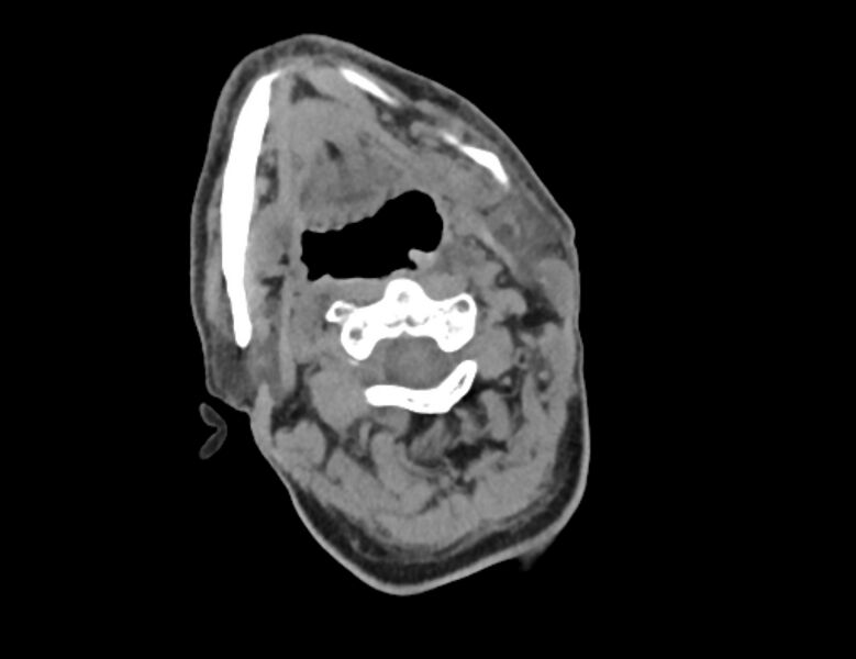 File:Carotid artery pseudoaneurysm (Radiopaedia 84030-99259 Axial non-contrast 10).jpg