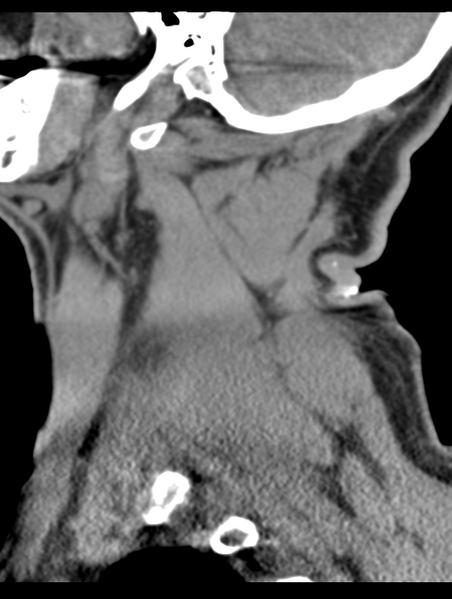 File:Cavernoma of cervical cord (Radiopaedia 50838-56346 B 13).png
