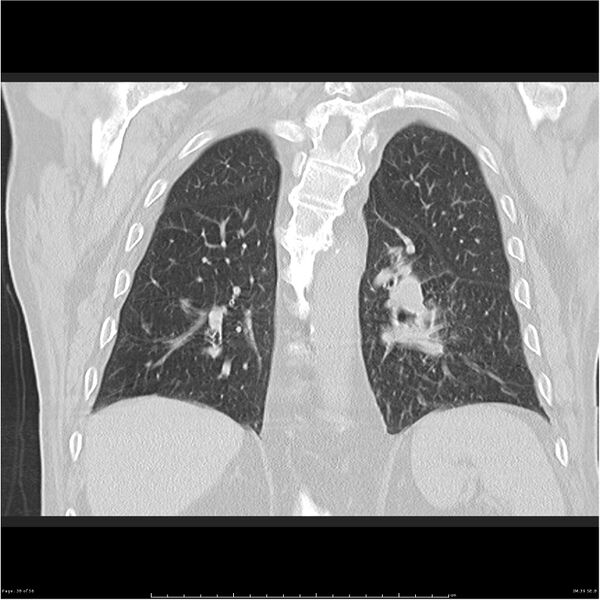 File:Cavitating left lower lobe lesion - squamous cell lung cancer (Radiopaedia 27749-28176 Coronal lung window 38).jpg