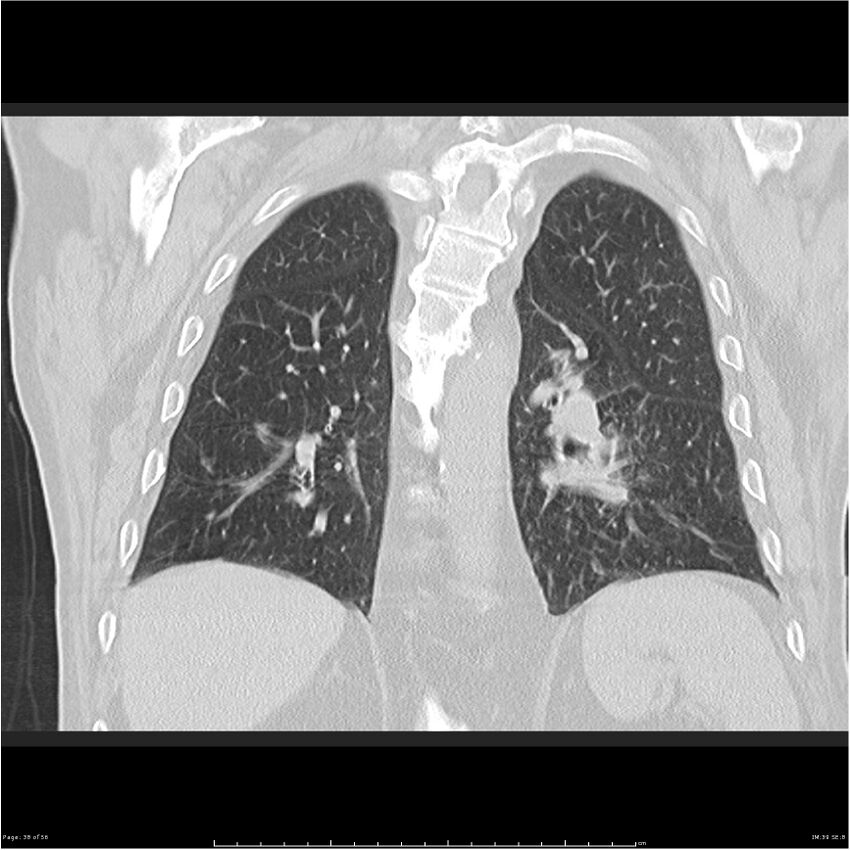 Cavitating left lower lobe lesion - squamous cell lung cancer (Radiopaedia 27749-28176 Coronal lung window 38).jpg