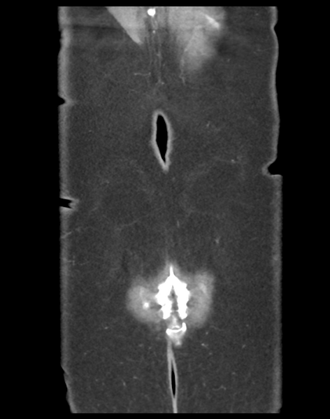 File:Cecum hernia through the foramen of Winslow (Radiopaedia 46634-51112 B 46).png
