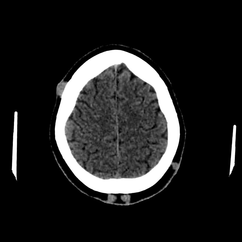 Central nervous system Langerhans cell histiocytosis (Radiopaedia 65728-74878 Axial non-contrast 43).jpg