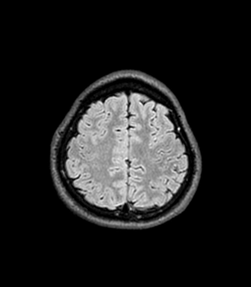 Central neurocytoma (Radiopaedia 79320-92380 Axial FLAIR 73).jpg