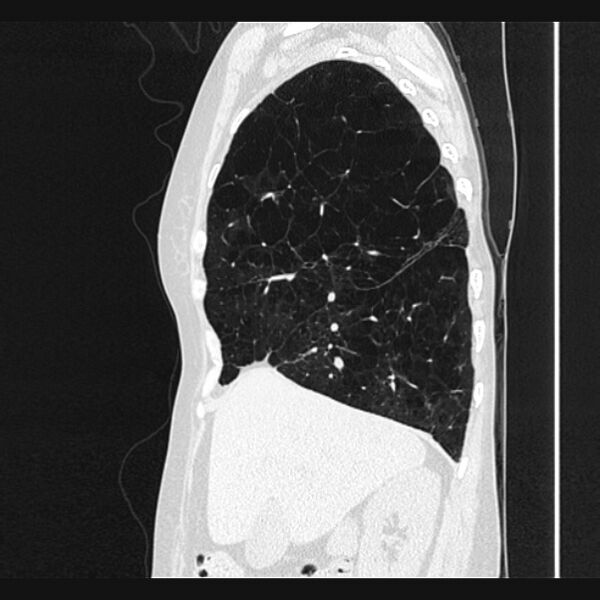 File:Centrilobular pulmonary emphysema (Radiopaedia 24495-24789 Sagittal lung window 23).jpg