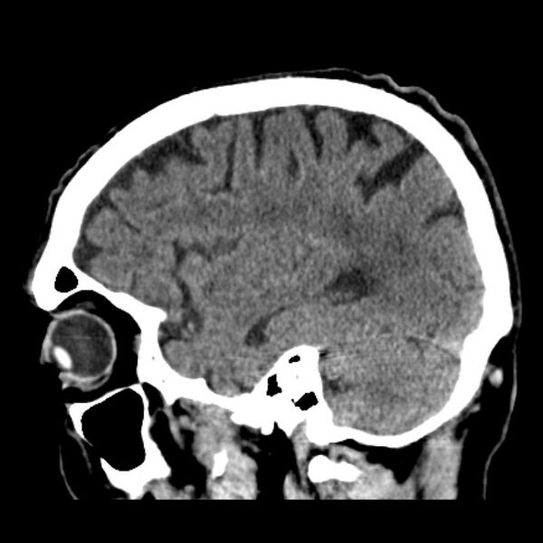 File:Cerebellar hemorrhage (Radiopaedia 27193-27359 C 13).jpg