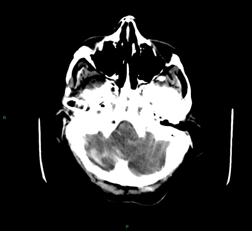 Cerebellar hemorrhage (Radiopaedia 58792-66026 Axial non-contrast 43).jpg