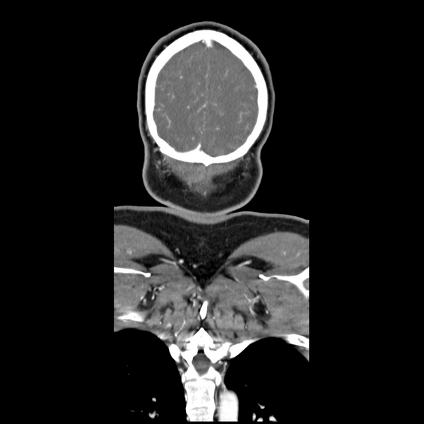 File:Cerebellar infarct due to vertebral artery dissection with posterior fossa decompression (Radiopaedia 82779-97029 D 58).png