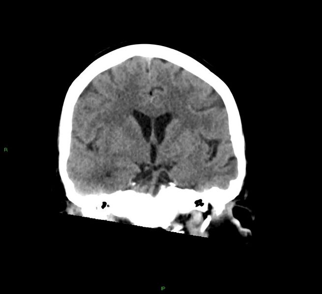 File:Cerebral amyloid angiopathy-associated lobar intracerebral hemorrhage (Radiopaedia 58378-65516 Coronal non-contrast 35).jpg