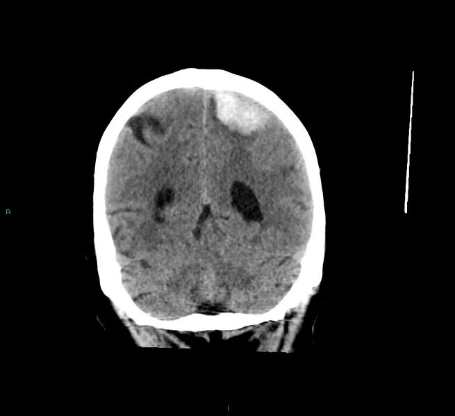 File:Cerebral amyloid angiopathy-associated lobar intracerebral hemorrhage (Radiopaedia 58529-65681 Coronal non-contrast 20).jpg