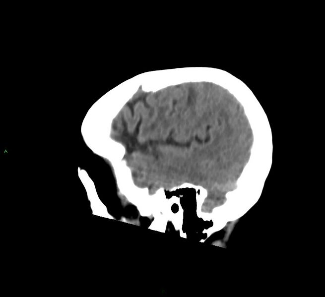 File:Cerebral amyloid angiopathy-associated lobar intracerebral hemorrhage (Radiopaedia 58530-65688 C 45).jpg