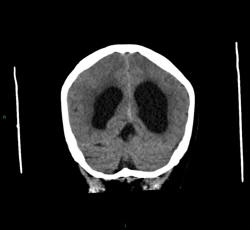 Cerebral amyloid angiopathy-associated lobar intracerebral hemorrhage (Radiopaedia 58560-65723 Coronal non-contrast 21).jpg