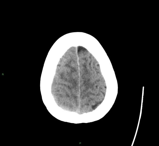 File:Cerebral amyloid angiopathy-associated lobar intracerebral hemorrhage (Radiopaedia 58563-65727 Axial non-contrast 12).jpg