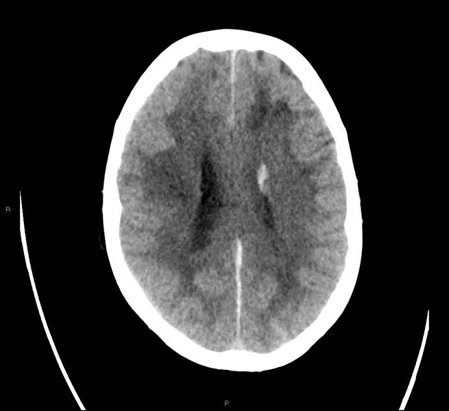 File:Cerebral amyloid angiopathy-associated lobar intracerebral hemorrhage (Radiopaedia 58566-65731 Axial non-contrast 16).jpg