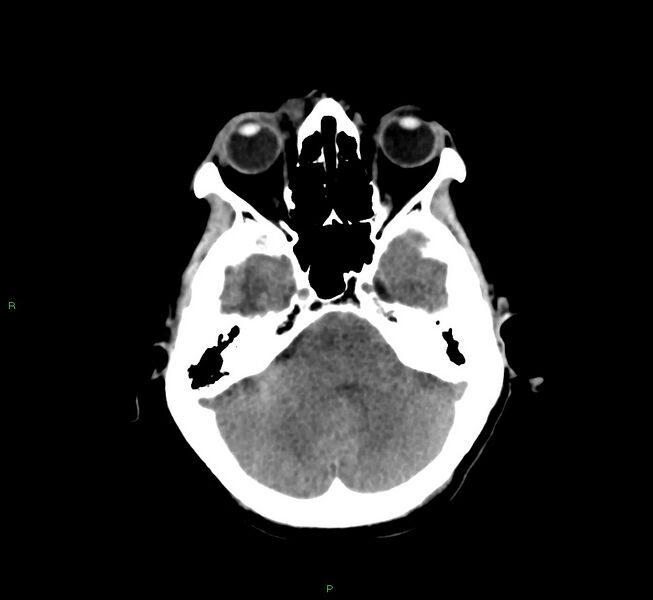 File:Cerebral amyloid angiopathy-associated lobar intracerebral hemorrhage (Radiopaedia 58751-65972 Axial non-contrast 38).jpg