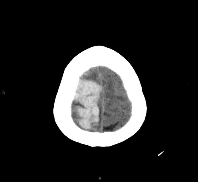 File:Cerebral amyloid angiopathy-associated lobar intracerebral hemorrhage (Radiopaedia 58751-65972 Axial non-contrast 8).jpg