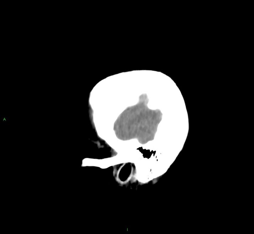 Cerebral amyloid angiopathy-associated lobar intracerebral hemorrhage (Radiopaedia 58752-65973 C 48).jpg