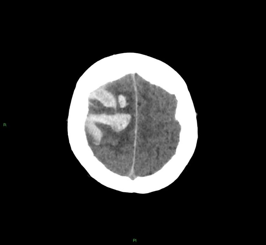 Cerebral amyloid angiopathy-associated lobar intracerebral hemorrhage (Radiopaedia 58756-65977 Axial non-contrast 12).jpg