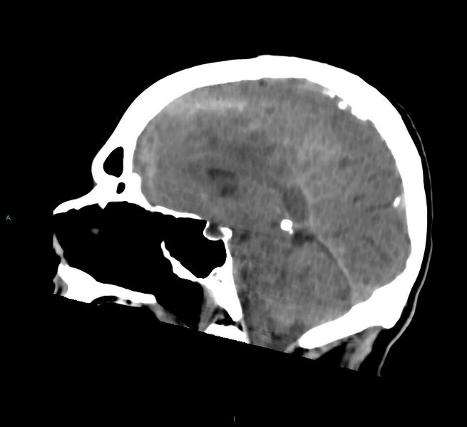 File:Cerebral amyloid angiopathy-associated lobar intracerebral hemorrhage (Radiopaedia 58756-65977 C 31).jpg
