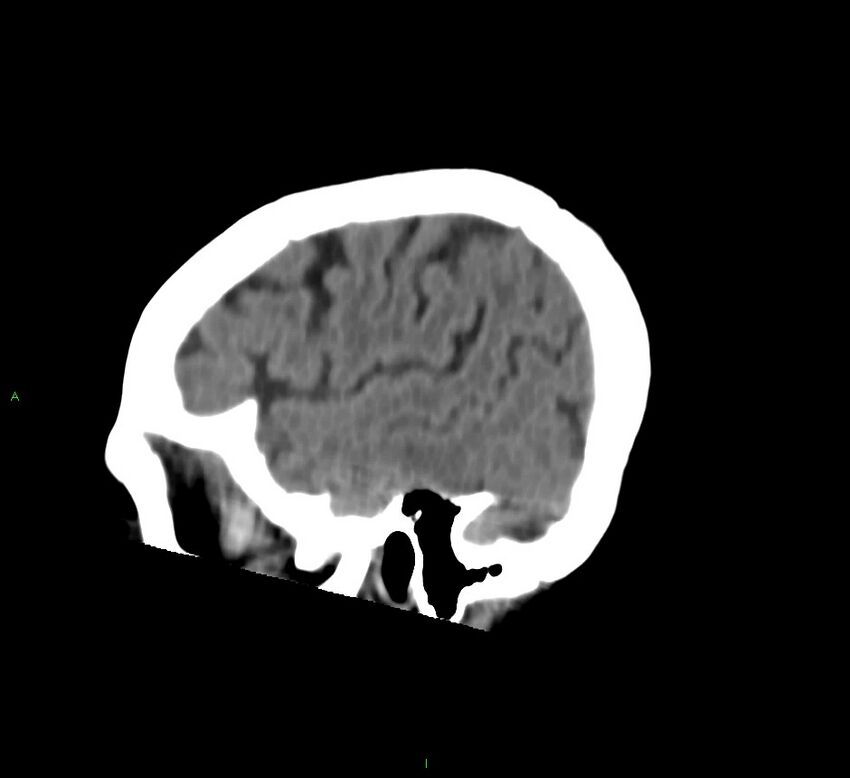 Cerebral amyloid angiopathy-associated lobar intracerebral hemorrhage (Radiopaedia 58757-65978 C 11).jpg
