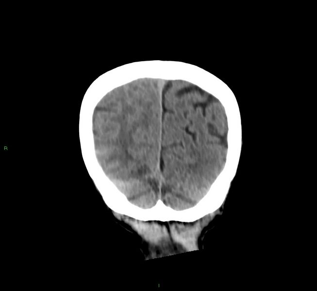 File:Cerebral amyloid angiopathy-associated lobar intracerebral hemorrhage (Radiopaedia 58758-65980 Coronal non-contrast 13).jpg