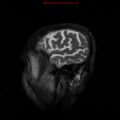 Cerebral and orbital tuberculomas (Radiopaedia 13308-13311 Sagittal T2 18).jpg