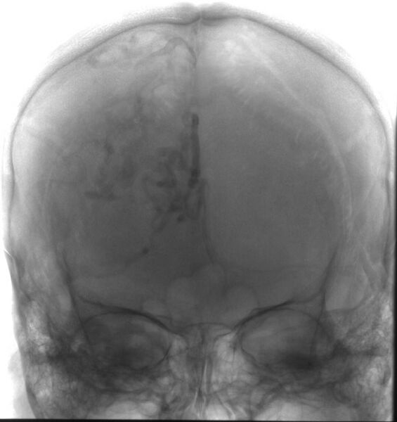 File:Cerebral arteriovenous malformation (Radiopaedia 10989-11408 J 1).jpg