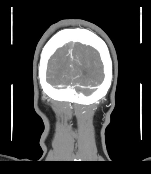 File:Cerebral dural venous sinus thrombosis (Radiopaedia 86514-102576 B 71).jpg