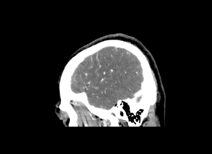 Cerebral edema (Radiopaedia 82519-96661 D 11).jpg