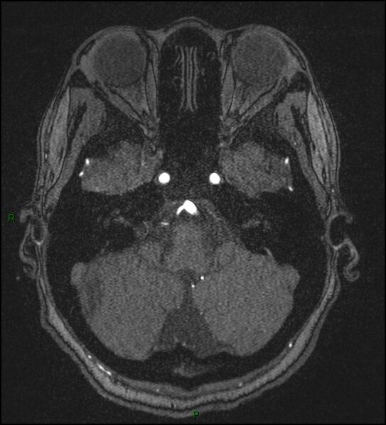 File:Cerebral fat embolism (Radiopaedia 35022-36525 Axial TOF 40).jpg