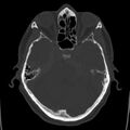 Cerebral hemorrhagic contusions (Radiopaedia 23145-23188 Axial bone window 17).jpg