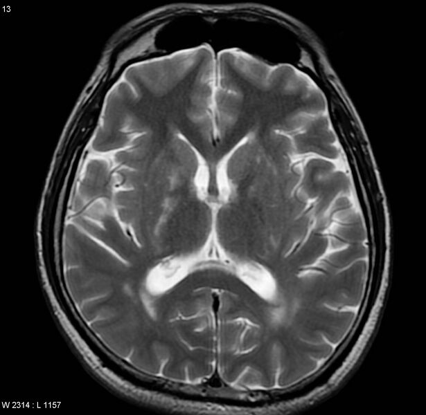 File:Cerebral vasculitis (Radiopaedia 5131-6923 Axial T2 4).jpg
