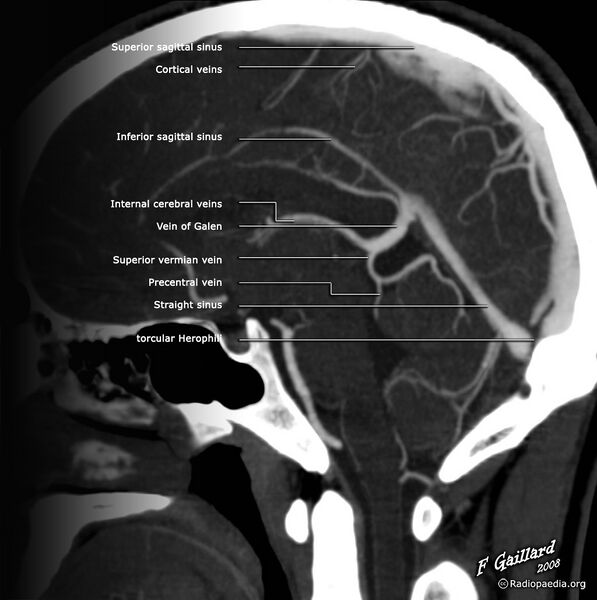 File:Cerebral veins (diagram) (Radiopaedia 36159).jpg