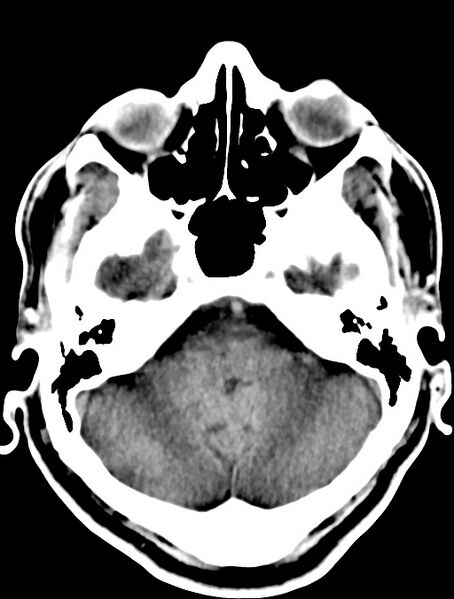 File:Cerebral venous angioma (Radiopaedia 69959-79977 Axial non-contrast 9).jpg