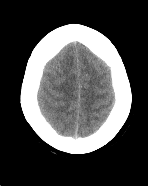 File:Cerebral venous infarct related to dural venous sinus thromboses (Radiopaedia 35292-36803 AXIAL THICK 23).png