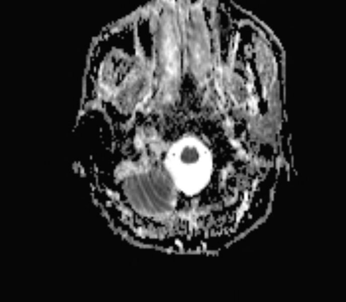 File:Cerebral venous thrombosis (Radiopaedia 71207-81504 Axial ADC 1).jpg