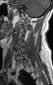 Cervical schwannoma (Radiopaedia 72399-82934 Sagittal T1 1).jpg