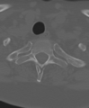 Cervical spine ACDF loosening (Radiopaedia 48998-54071 Axial bone window 54).png