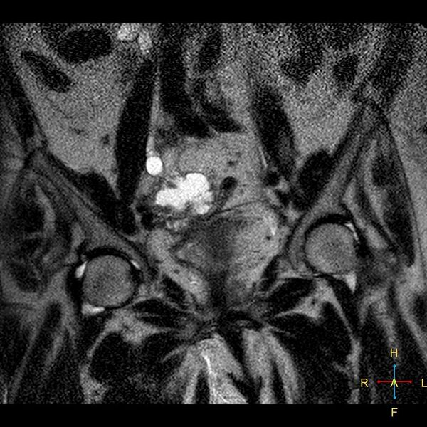 File:Cervical stump squamous cell carcinoma (Radiopaedia 48049-52858 Coronal T2 5).jpg