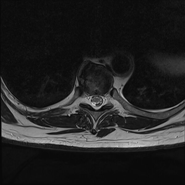 File:Cervical tumor-like myelopathy due to Type V dAVF (Radiopaedia 82461-96604 D 33).jpg