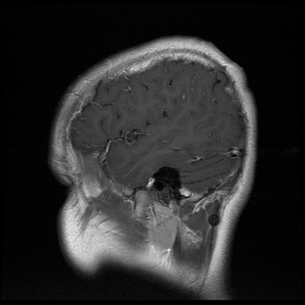 File:Chiasmatic-hypothalamic juvenile pilocytic astrocytoma (Radiopaedia 78533-91236 Sagittal T1 C+ 21).jpg