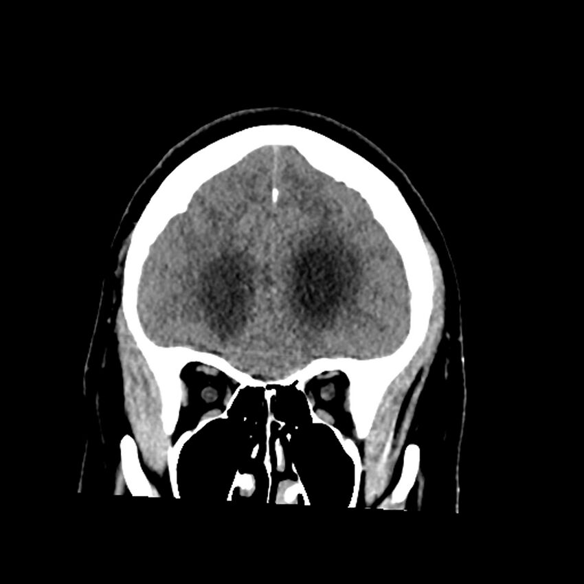 Chiasmatic-hypothalamic juvenile pilocytic astrocytoma (Radiopaedia 78533-91237 Coronal non-contrast 20).jpg
