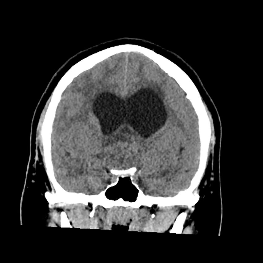 Chiasmatic-hypothalamic juvenile pilocytic astrocytoma (Radiopaedia 78533-91237 Coronal non-contrast 31).jpg