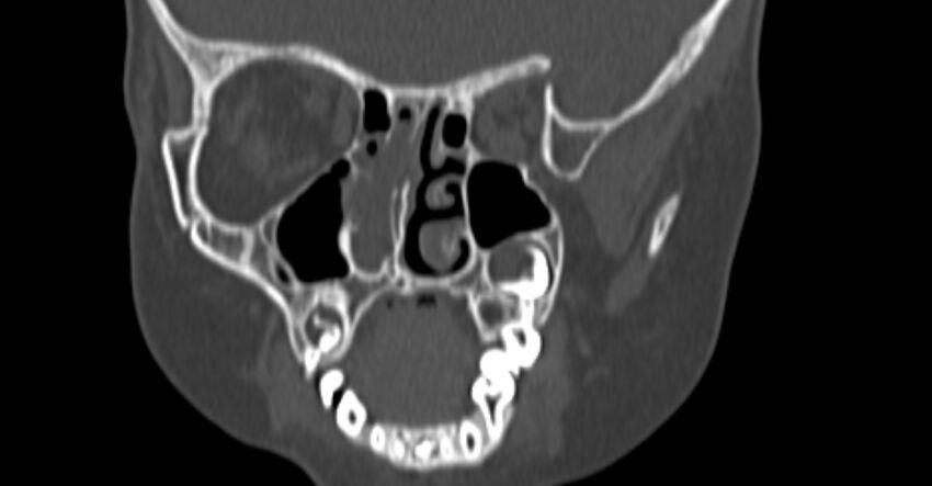 Choanal atresia (Radiopaedia 51295-56972 Coronal bone window 43).jpg